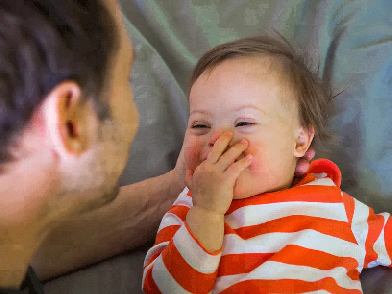 Síndrome de Down: o que é e como ajudar a criança Síndrome de Down